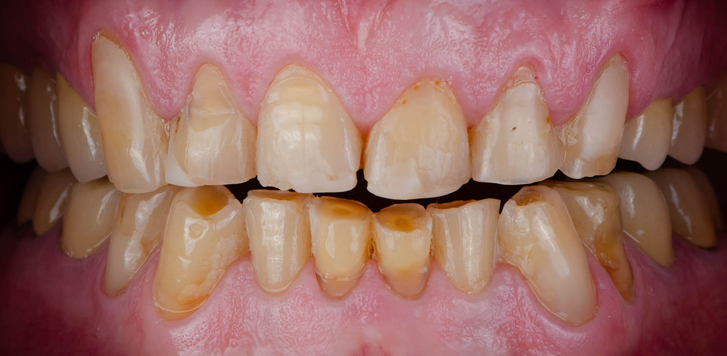 Discoloured Or Stained Teeth