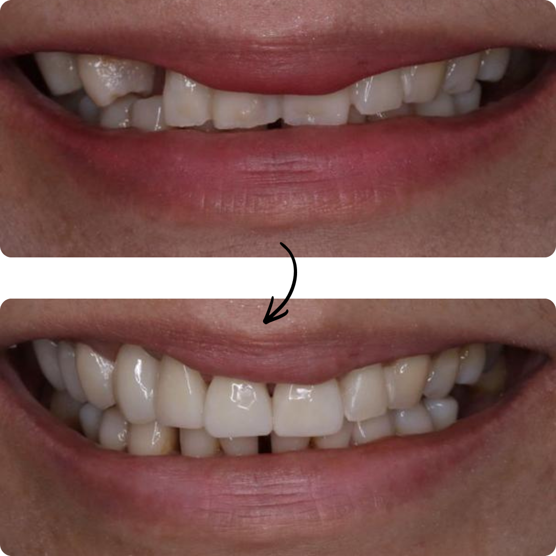 Before and after veneers result 3
