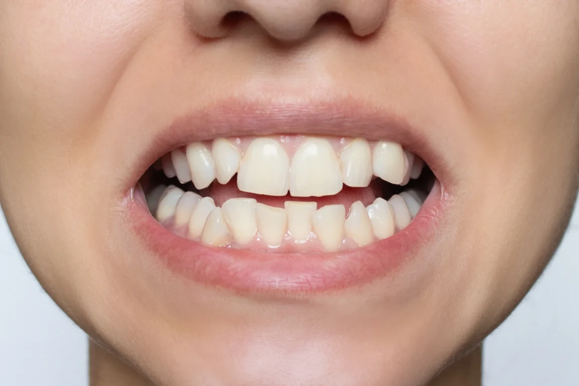 Small / Short Looking Teeth