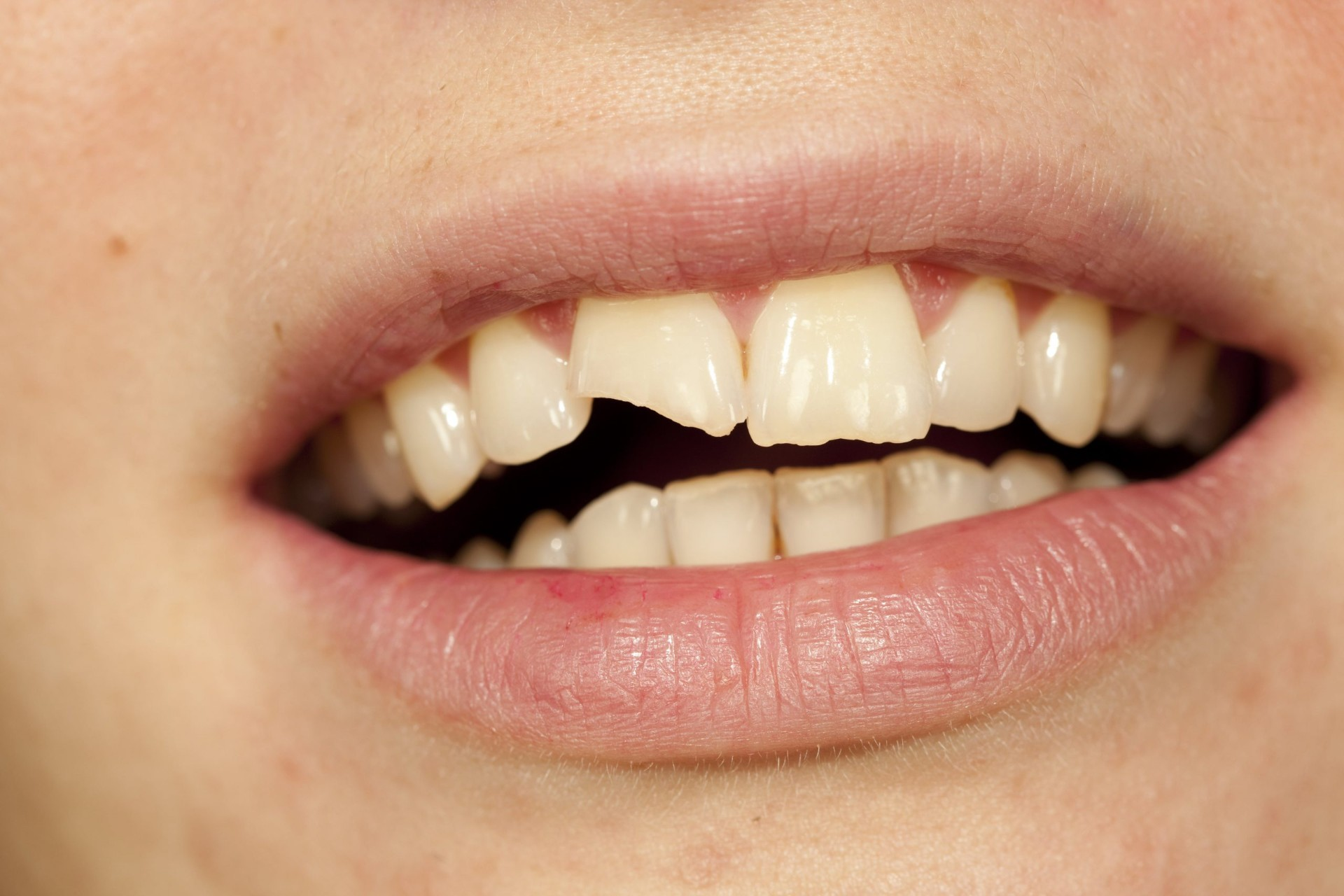 Chipped Or Cracked Teeth