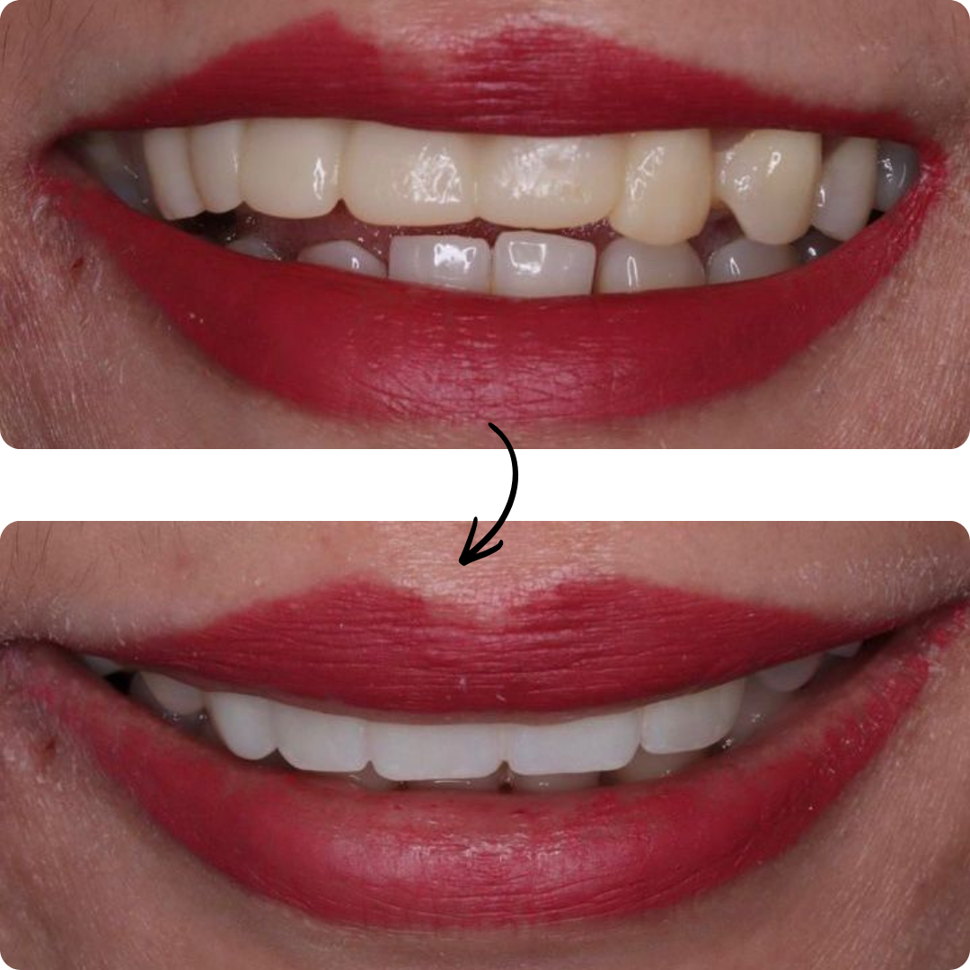 Before and after veneers result 4