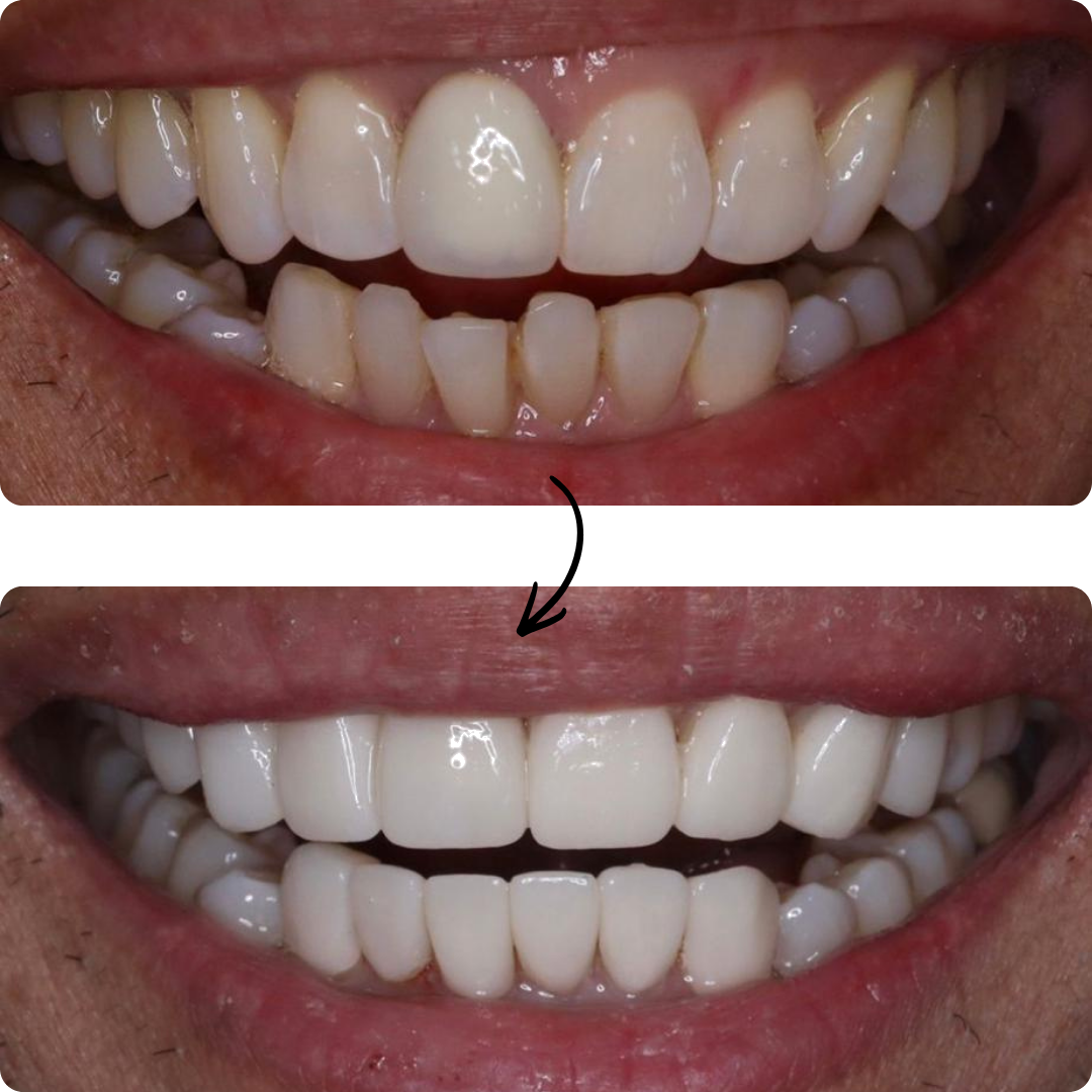 Before and after veneers result 1