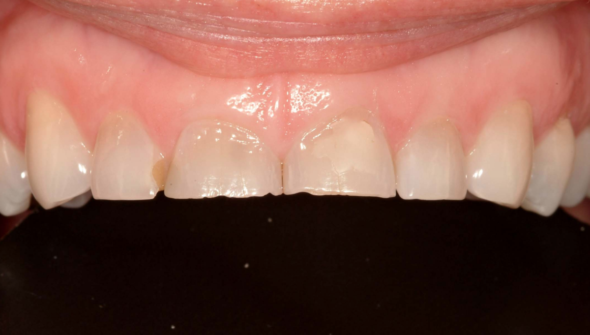 Worn Tooth Edges