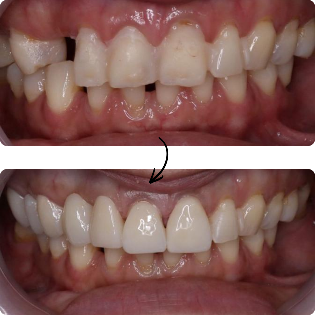 Before and after veneers result 2